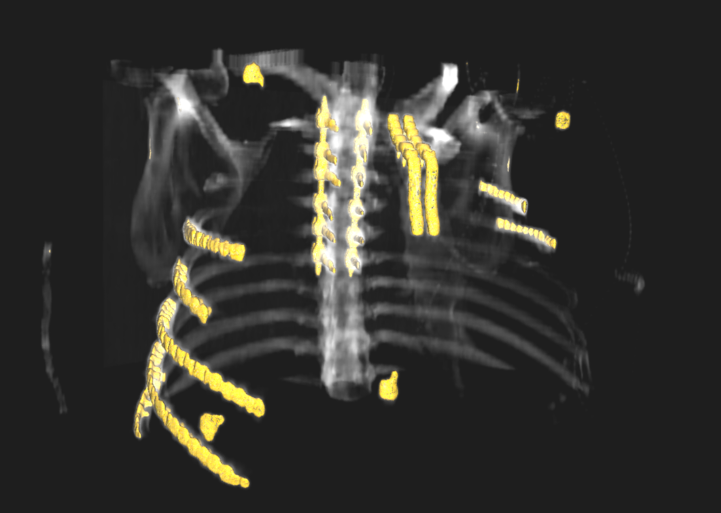 cat scan of a ribcage